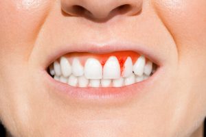 gums bleed when flossing