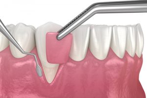 receding gums from dip