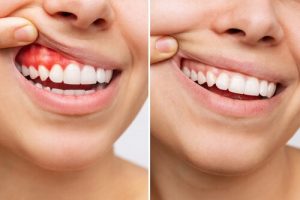 healthy gums tend periodontal surgery