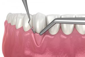 connective tissue graft