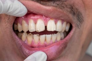 gum recession occurs