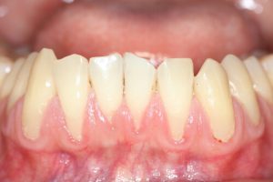 tooth loss