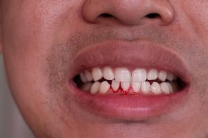 single tooth deep inflamed gum